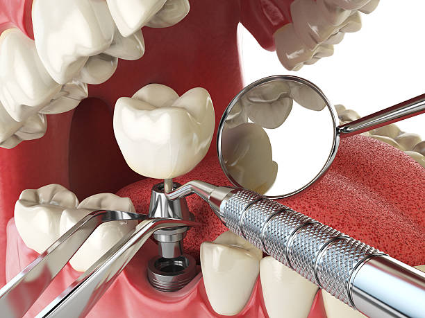Best Emergency Root Canal Treatment in Bethesda, OH
